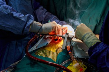 Açık kalp ameliyatı sırasında ekip cerrahları klinikteki tıbbi prosedür sırasında ellerinde cerrahi aletler tutuyorlar.