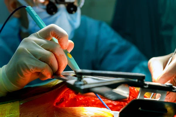 Хирурги Работающие Ножницами Над Пациентом Открытой Операционной Кардиохирурга — стоковое фото