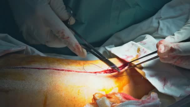 Surgeons suturing a long on sick patient after performing a serious surgery. — Stock Video