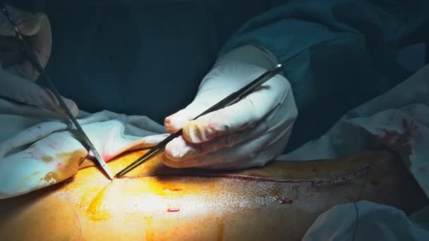 Doctor stitching a patients foot after surgery. — Stock Video