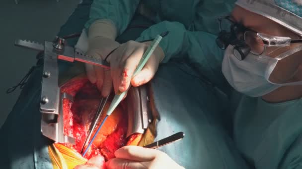 Cirujanos trabajando con una tijera en un paciente en un quirófano — Vídeos de Stock