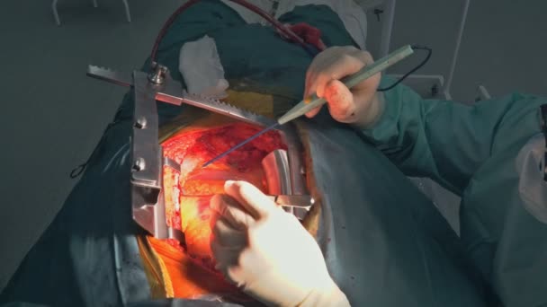 Ein Chirurg führt koronare Arterienbypass Transplantation am offenen Herzen durch. — Stockvideo