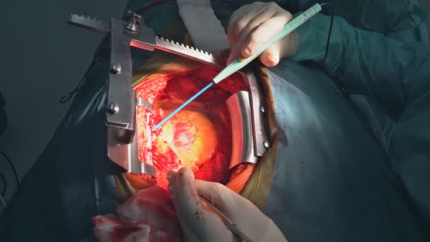Hjärtkirurgi. Öppet hjärta operation sutur större ytlig ven — Stockvideo