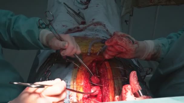 Chirurgové ruce prošívání tkání hlavy po vrtání na jádro — Stock video