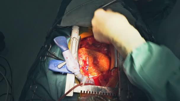 Surgeon with surgical instrument during the open heart operation — Stock Video