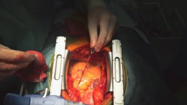 Kalp ameliyatı. Açık kalp ameliyatı dikiş büyük safen ven