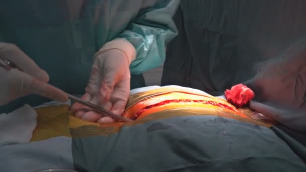 Team surgeon at work in operating room. Surgical light in the operating room. Preparation for the beginning of surgical operation with a cut. — Stock Video