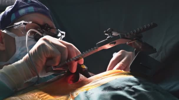 Surgeons working with a scissors on a patient in a operating theater — Stock Video