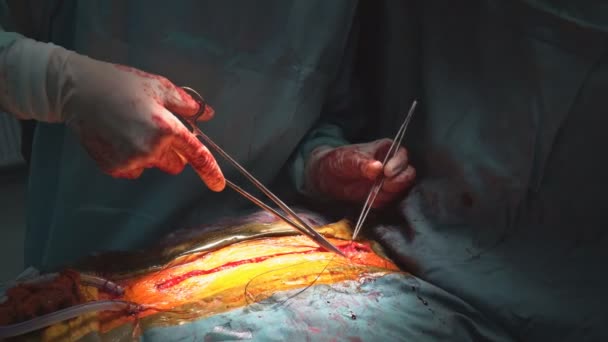 Хирург зашивает рану после операции в больнице — стоковое видео