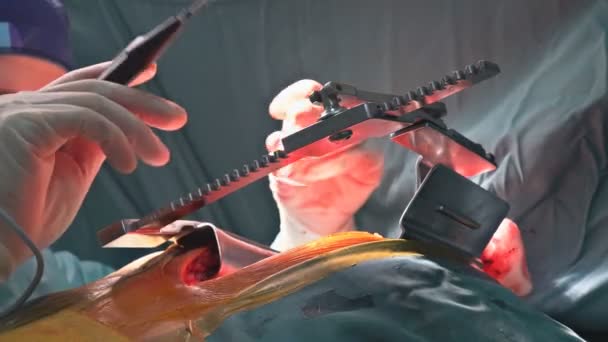 Операция и команда хирургов выполняют операции на грудной клетке в случае рака легких — стоковое видео