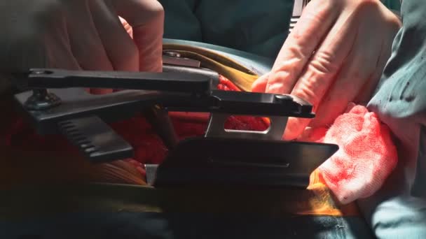 Naht Einer Lungenemphysem Operation Bei Einem Säugling Undmedizinische Hilfe Aus — Stockvideo