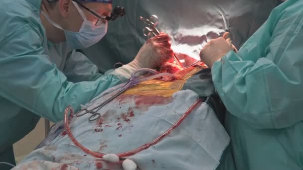 开胸手术期间的团队精神外科医生在诊所的医疗过程中手持手术器械 — 图库视频影像