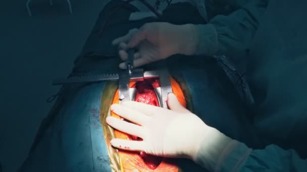 Ein Chirurg führt koronare Arterienbypass Transplantation am offenen Herzen durch. — Stockvideo