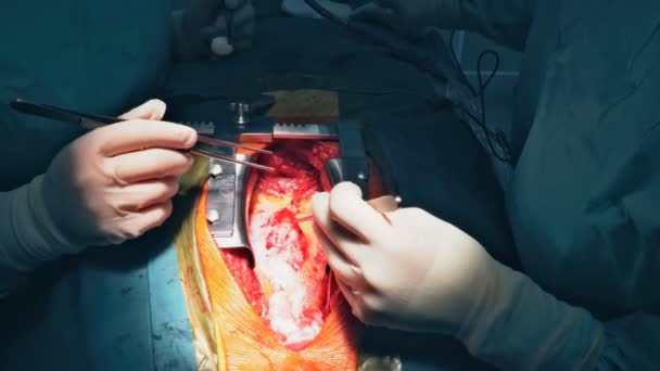 Cirugía y equipo de cirujanos realizan cirugía torácica en caso de cáncer de pulmón — Vídeos de Stock