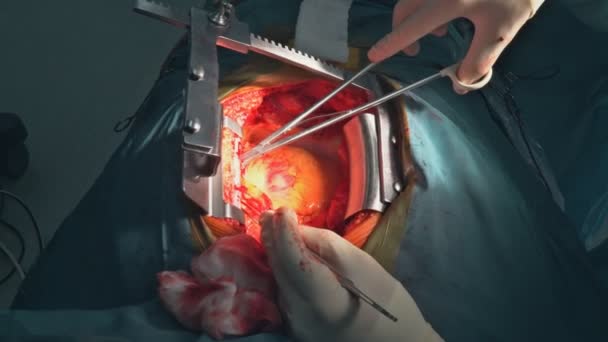 Surgeon operating live shot Surgeons team operating heart. — Stock Video