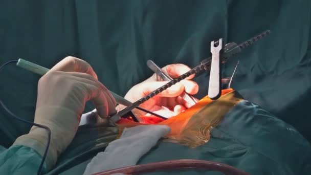 Teamwork surgeons during open heart surgery doctor holding surgical instruments — Stock Video