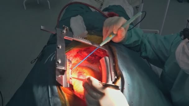 Kirurger arbetar med en sax på en patient i en fungerande teater外科医生对一个病人在手术室工作用剪刀 — Stockvideo