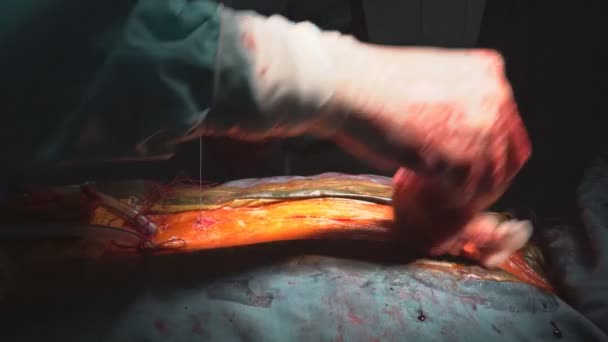 Doctor sews up the patient after surgery for heart surgeon open operating — Stock Video