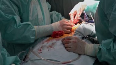 Koroner arter bypass greft cerrahisi closeup. 4 k görüntüleri