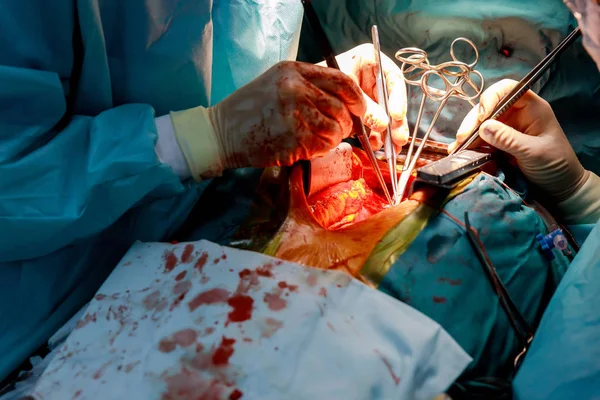 Cirujanos Trabajando Con Una Tijera Paciente Cirujano Cardíaco Quirófano Abierto —  Fotos de Stock