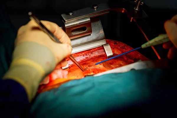 Tüdősebész Csapat Mellkasi Műtétet Végez Tüdőrákban — Stock Fotó