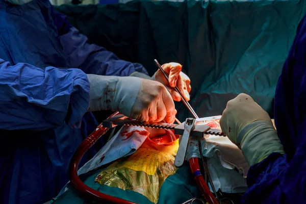 A surgeon performs coronary artery bypass grafting open heart surgery artery