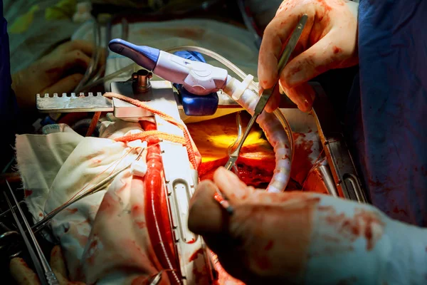 Heart surgery. Open heart surgery suture greater saphenous vein coronary artery bypass surgery