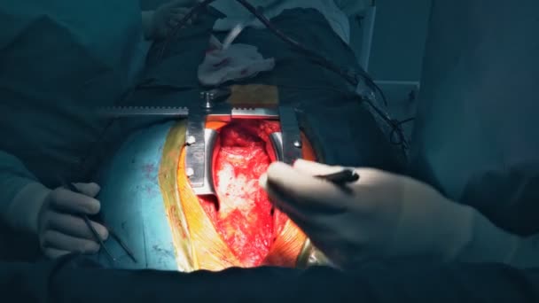 Riktiga hjärtat slår under verklig kirurgi. Hjärtkirurgi. — Stockvideo