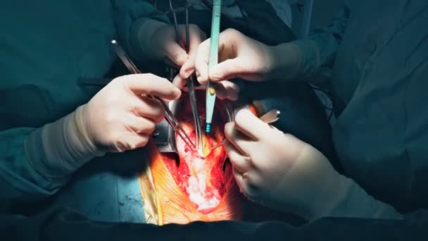 Fechamento da cirurgia de revascularização do miocárdio. Filmagem 4K — Vídeo de Stock