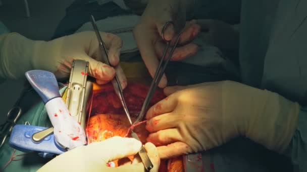 Suture d'un emphysème pulmonaire chirurgie chez un nourrisson, assistance médicale gros plan — Video