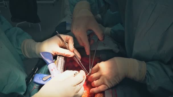 Operacji serca. Otwartym sercu chirurgii szwów większe żyły odpiszczelowej — Wideo stockowe