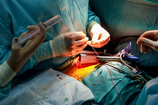 El cirujano hace un cirujano de la operación en la sala de operaciones con sangre — Foto de Stock