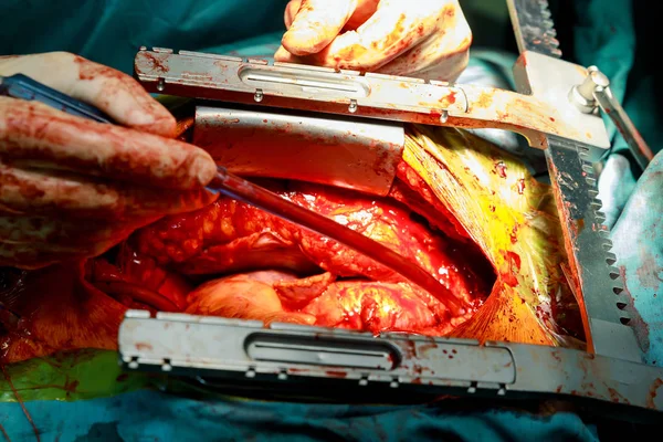Chirurgia cardiaca. Chirurgia a cuore aperto sutura maggiore vena safena — Foto Stock