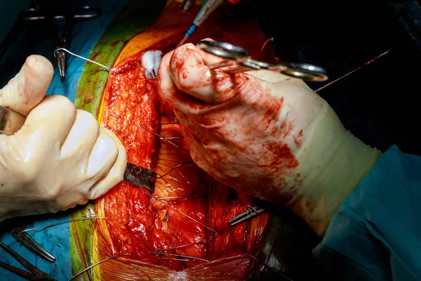 Cerrar el pecho después de una cirugía cardíaca — Foto de Stock