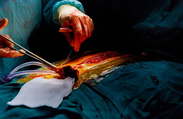 Un médico está cosiendo la piel después de una cirugía cardíaca en el quirófano —  Fotos de Stock