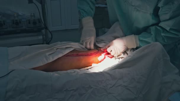 Ferida na perna com ferramentas cirúrgicas durante a operação varizes, cirurgia vascular — Vídeo de Stock