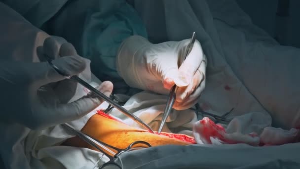 Chirurgia per l'innesto di bypass coronarico in sala operatoria — Video Stock