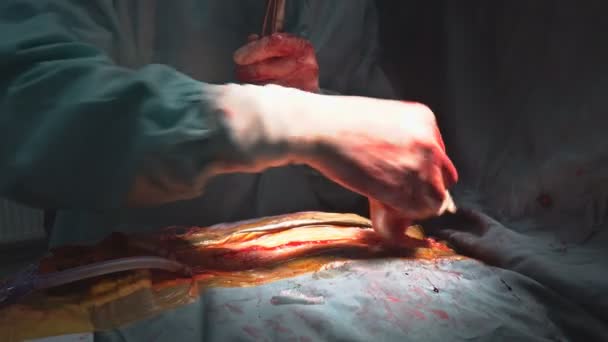 Operating room in the doctors team wear blue coat perform heart surgery the hospital. — Stock Video