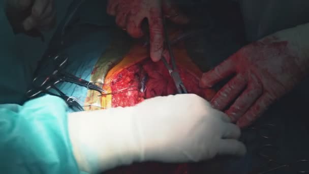 Nahaufnahme genähter Wunde nach Herz-Bypass-Operation im Operationssaal — Stockvideo