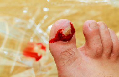 Hasarlı ayak tırnakları ile erkek bacak detay.