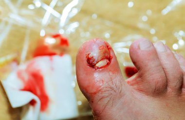 Bacaklarda tırnak hasarı kan tırnağı yırtılmış