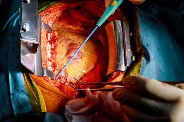 Cirugía cardiaca en quirófano — Foto de Stock