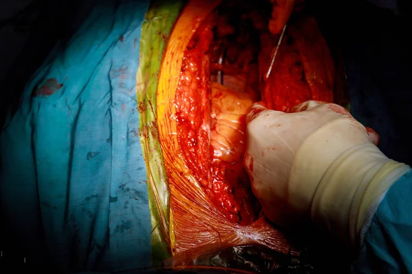 Médico de cirugía en el centro de cirugía para cirugía a corazón abierto — Foto de Stock