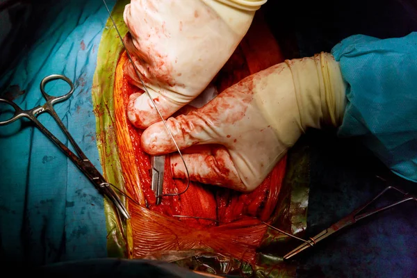 Cirujano manos el procedimiento a corazón abierto —  Fotos de Stock