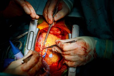 Heart surgery. Open heart surgery suture greater saphenous vein clipart