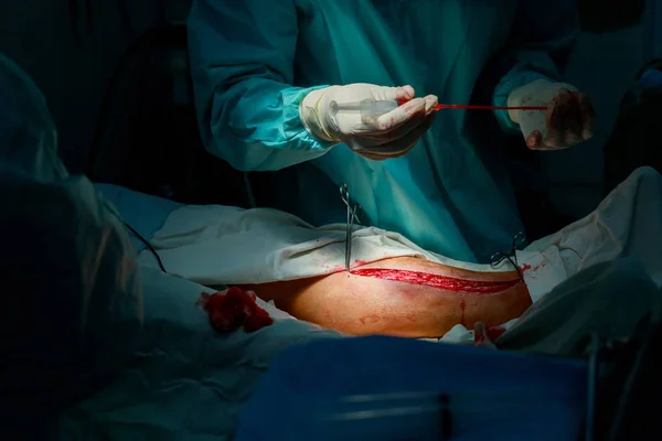 Un cirujano escoge una cirugía de derivación de pierna a corazón — Foto de Stock