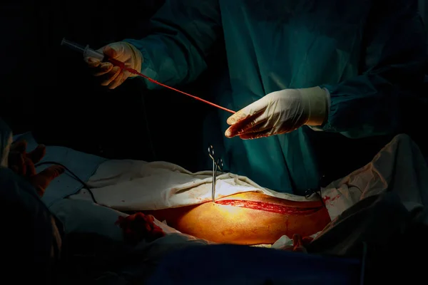 Surgery for Coronary Artery Bypass Grafting operation in the operating room — Stock Photo, Image