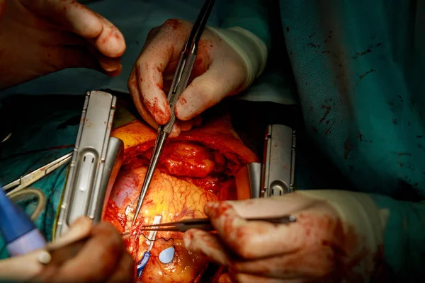 Ein Chirurg führt koronare Arterienbypass Transplantation am offenen Herzen durch. — Stockfoto