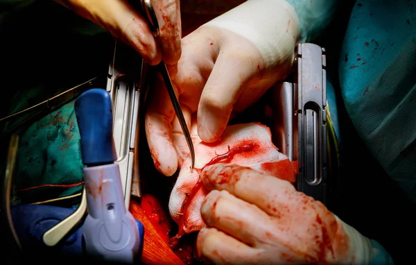 Хирургическое вмешательство при заболевании коронарной артерии с использованием вненасосной техники — стоковое фото