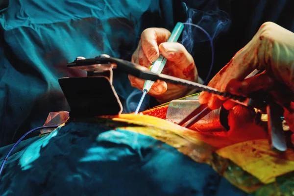 Leikkaus leikkaussali sähköpoltin laitteet sydän- ja verisuonitautien hätäkirurgia keskus . — kuvapankkivalokuva